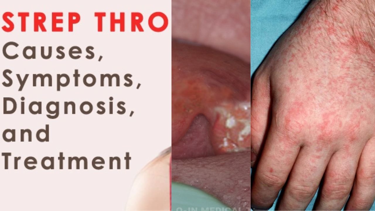 Understanding Strep Throat: Symptoms, Solutions, and Safeguards"