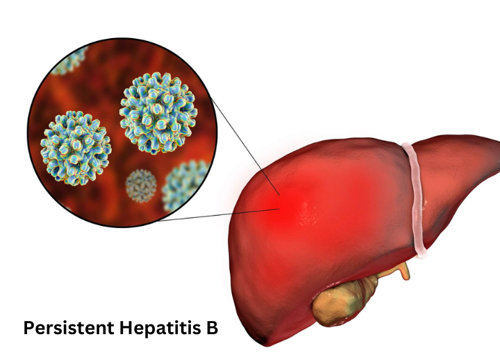 Persistent Hepatitis B